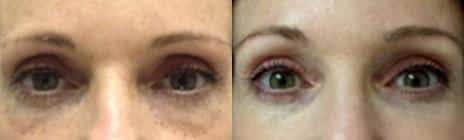 Non-Surgical Liquid Eye lift Before and After Photos in New York, NY, Patient 11431