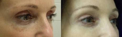 Non-Surgical Liquid Eye lift Before and After Photos in New York, NY, Patient 11431