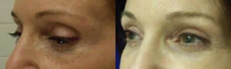 Non-Surgical Liquid Eye lift Before and After Photos in New York, NY, Patient 11431