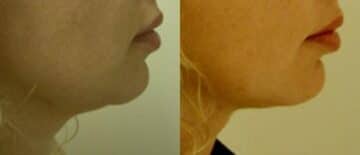 Neck Liposuction Before and After Photos in New York, NY, Patient 11441