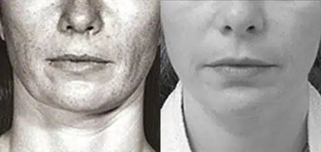 Neck Liposuction Before and After Photos in New York, NY, Patient 11449