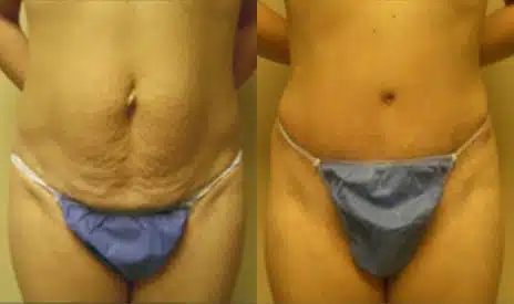 Tummy Tuck Before and After Photos in New York, NY, Patient 8543