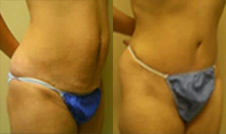 Tummy Tuck Before and After Photos in New York, NY, Patient 8543