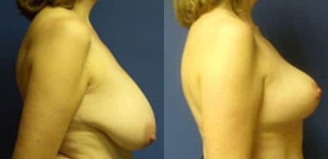 Breast Reduction Before and After Photos in New York, NY, Patient 11001