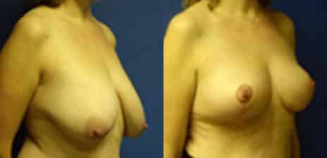 Breast Reduction Before and After Photos in New York, NY, Patient 11001