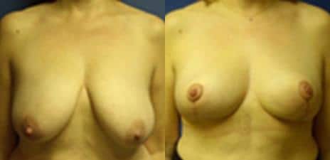 Breast Reduction Before and After Photos in New York, NY, Patient 11001