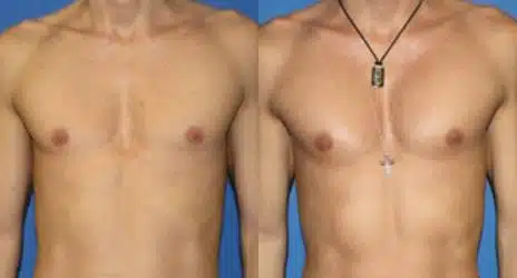 Patient 11081, Pectoral Augmentation Before and After Photos Pectoral Augmentation Before and After Photos in New York, NY, Patient 11081