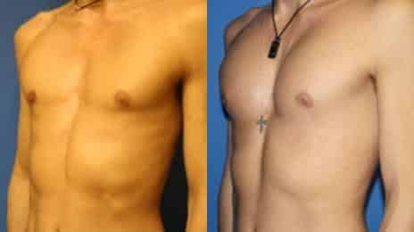 Patient 11081, Pectoral Augmentation Before and After Photos Pectoral Augmentation Before and After Photos in New York, NY, Patient 11081