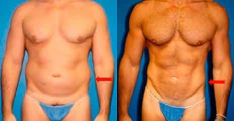 Hi-Def Liposuction Before and After Photos in New York, NY, Patient 11269