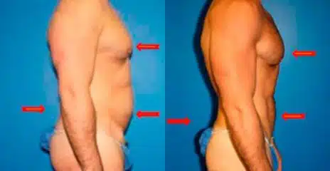 Hi-Def Liposuction Before and After Photos in New York, NY, Patient 11269