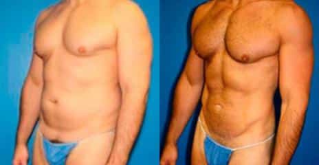 Patient 11269, Hi-Def Liposuction Before and After Photos Hi-Def Liposuction Before and After Photos in New York, NY, Patient 11269