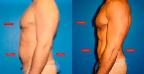 Hi-Def Liposuction Before and After Photos in New York, NY, Patient 11269