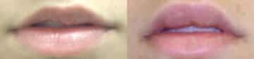 Lip Augmentation Before and After Photos in New York, NY, Patient 11413