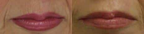 Lip Lines Before and After Photos in New York, NY, Patient 11458