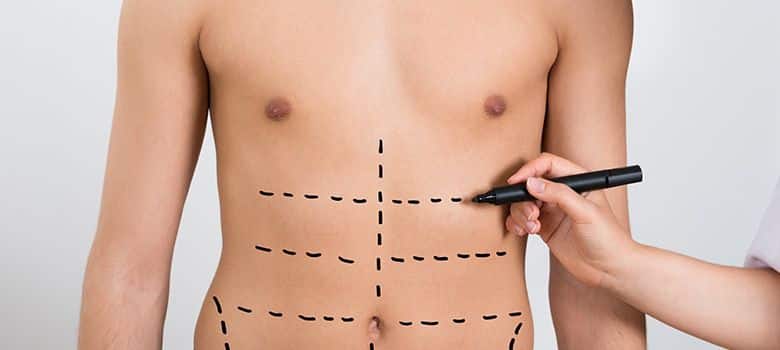 Hi Def Liposculpting for Men in New York, NY
