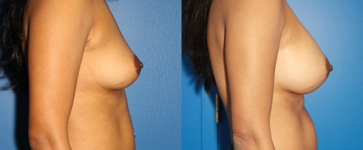 Breast Augmentation Before and After Photos in New York, NY, Patient 13512