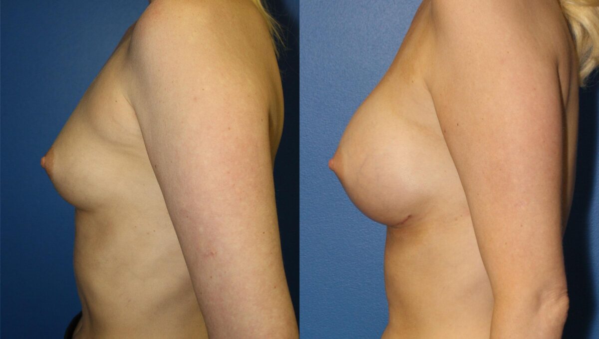 Breast Augmentation Before and After Photos in New York, NY, Patient 13541