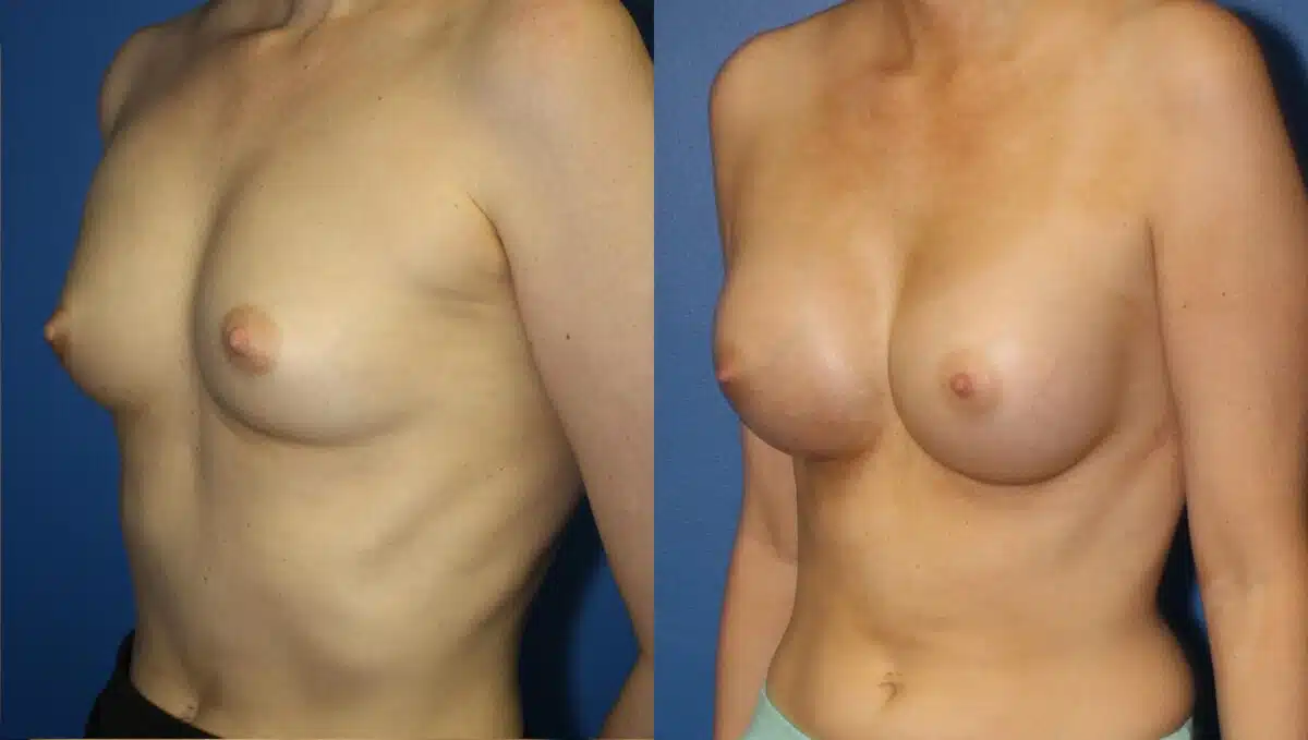 Breast Augmentation Before and After Photos in New York, NY, Patient 13541