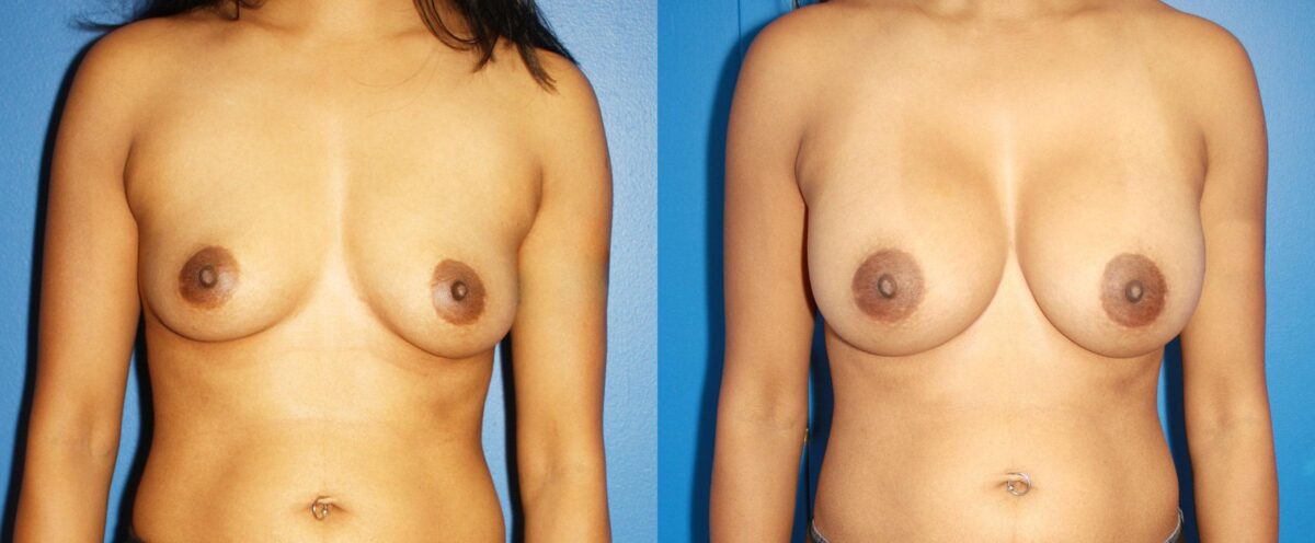 Breast Augmentation Before and After Photos in New York, NY, Patient 13512