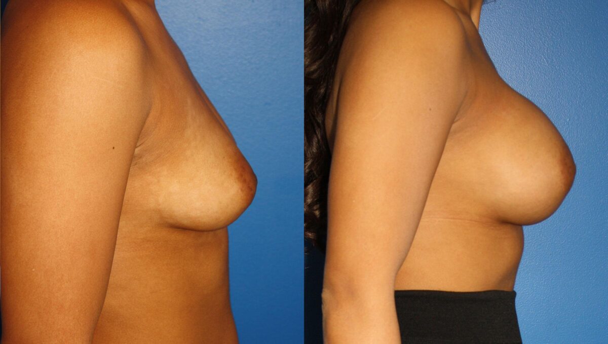 Breast Augmentation Before and After Photos in New York, NY, Patient 13551