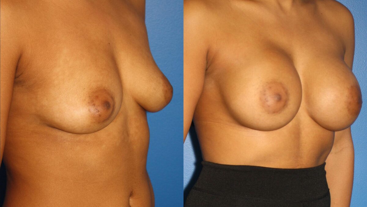 Breast Augmentation Before and After Photos in New York, NY, Patient 13551