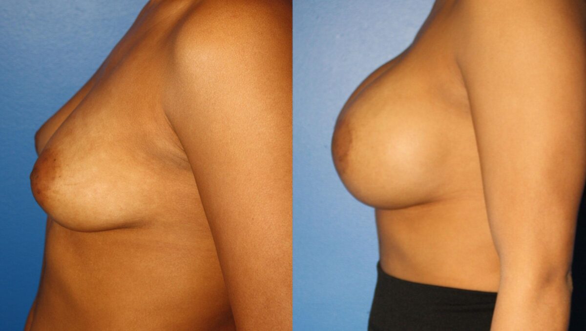 Breast Augmentation Before and After Photos in New York, NY, Patient 13551