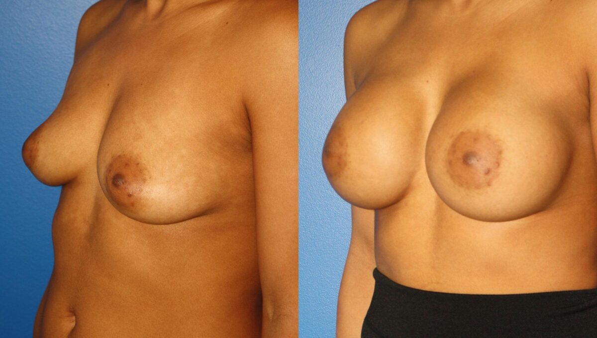 Breast Augmentation Before and After Photos in New York, NY, Patient 13551