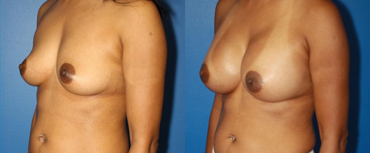 Breast Augmentation Before and After Photos in New York, NY, Patient 13512