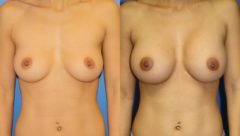 Breast Augmentation Before and After Photos in New York, NY, Patient 13525