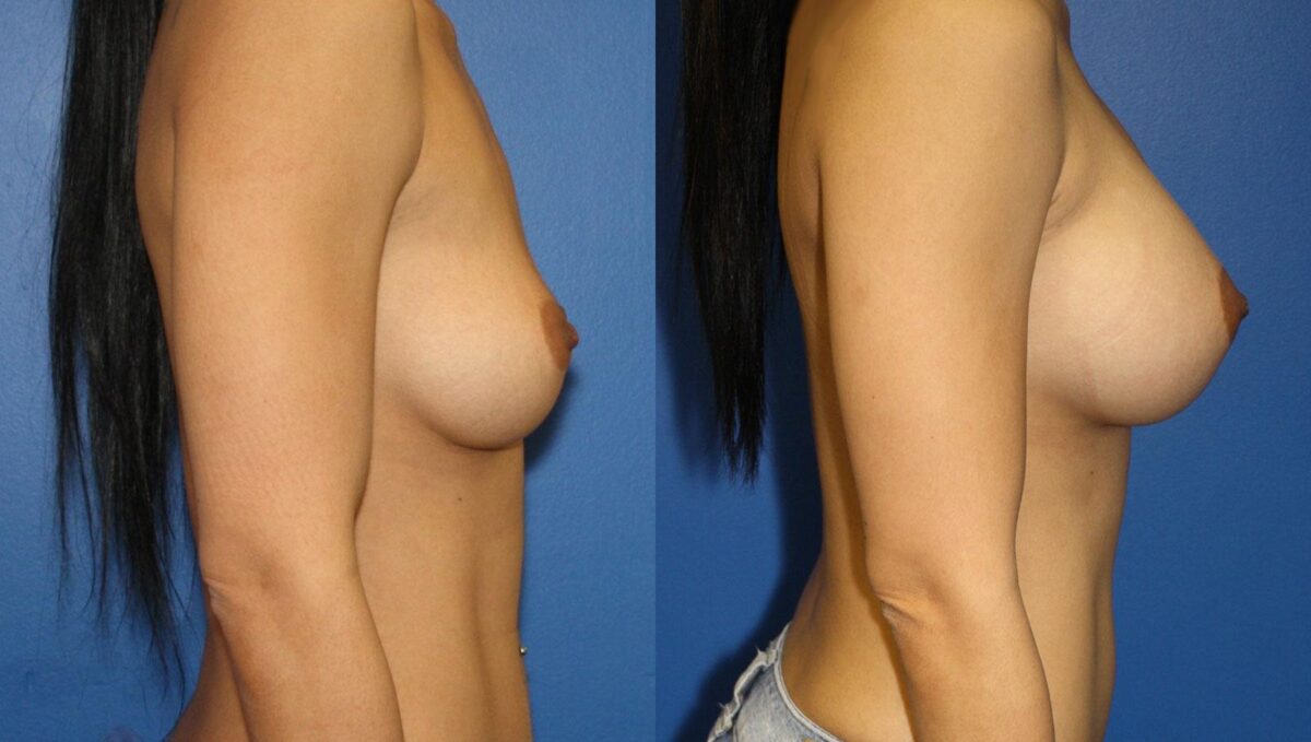 Breast Augmentation Before and After Photos in New York, NY, Patient 13525
