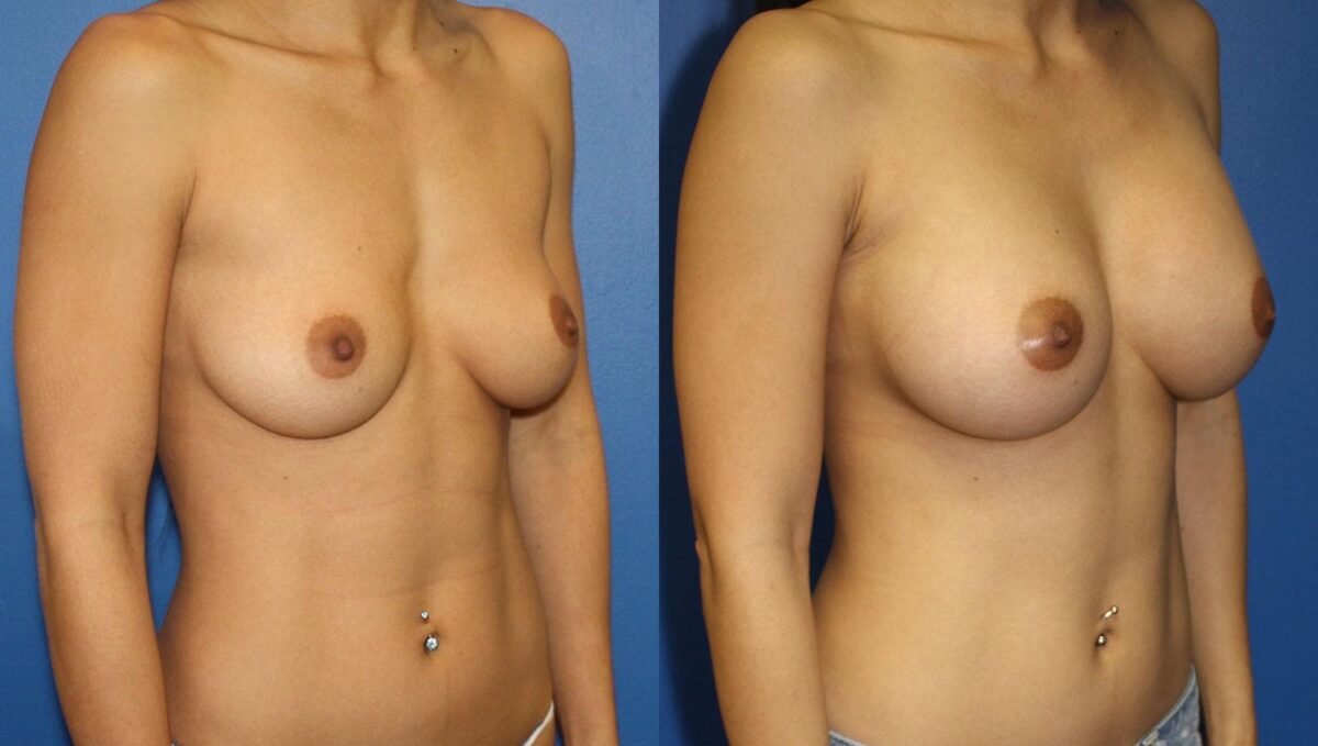 Breast Augmentation Before and After Photos in New York, NY, Patient 13525