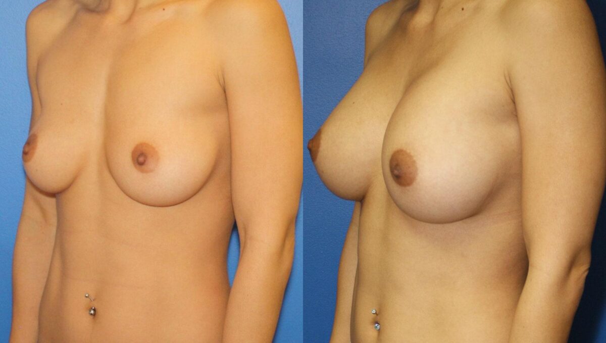 Breast Augmentation Before and After Photos in New York, NY, Patient 13525