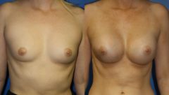 Breast Augmentation Before and After Photos in New York, NY, Patient 13541