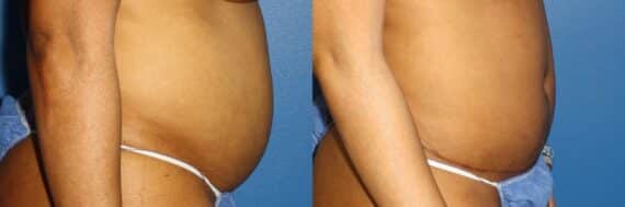 Tummy Tuck Before and After Photos in New York, NY, Patient 13596