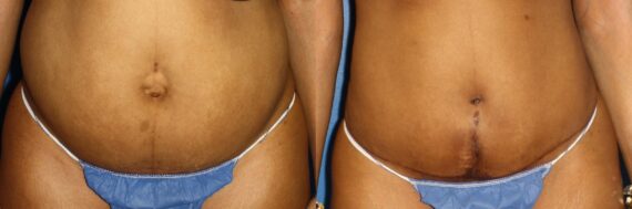 Tummy Tuck Before and After Photos in New York, NY, Patient 13596