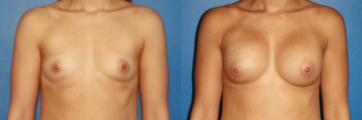Breast Augmentation Before and After Photos in New York, NY, Patient 13774