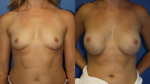 Breast Augmentation Before and After Photos in New York, NY, Patient 13959