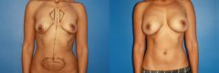 Breast Augmentation Before and After Photos in New York, NY, Patient 13756