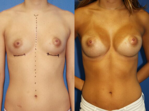 Breast Augmentation Before and After Photos in New York, NY, Patient 13822