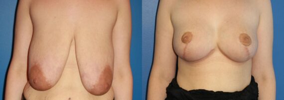 Breast Augmentation Before and After Photos in New York, NY, Patient 13876