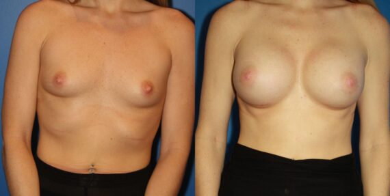 Breast Augmentation Before and After Photos in New York, NY, Patient 13908