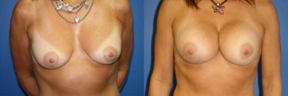 Breast Augmentation Before and After Photos in New York, NY, Patient 13942