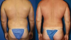 Gluteal Augmentation Before and After Photos in New York, NY, Patient 13690