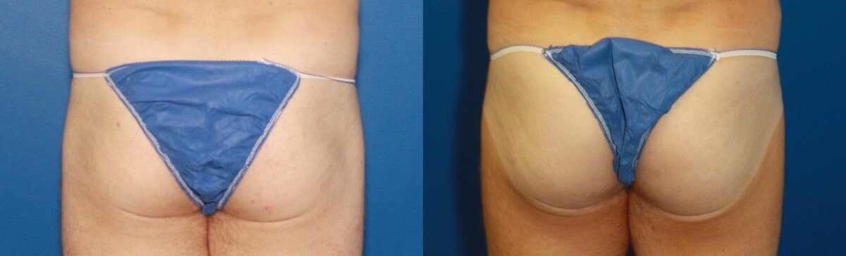 Gluteal Augmentation Before and After Photos in New York, NY, Patient 13686