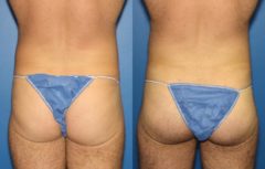 Gluteal Augmentation Before and After Photos in New York, NY, Patient 13742