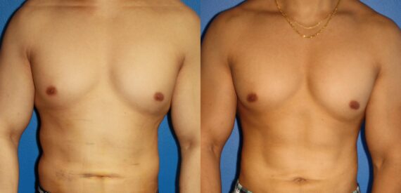 Hi-Def Liposuction Before and After Photos in New York, NY, Patient 13672