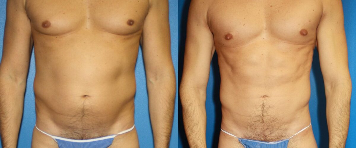 Hi-Def Liposuction Before and After Photos in New York, NY, Patient 13626