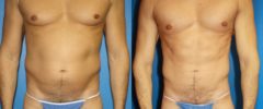 Hi-Def Liposuction Before and After Photos in New York, NY, Patient 13626