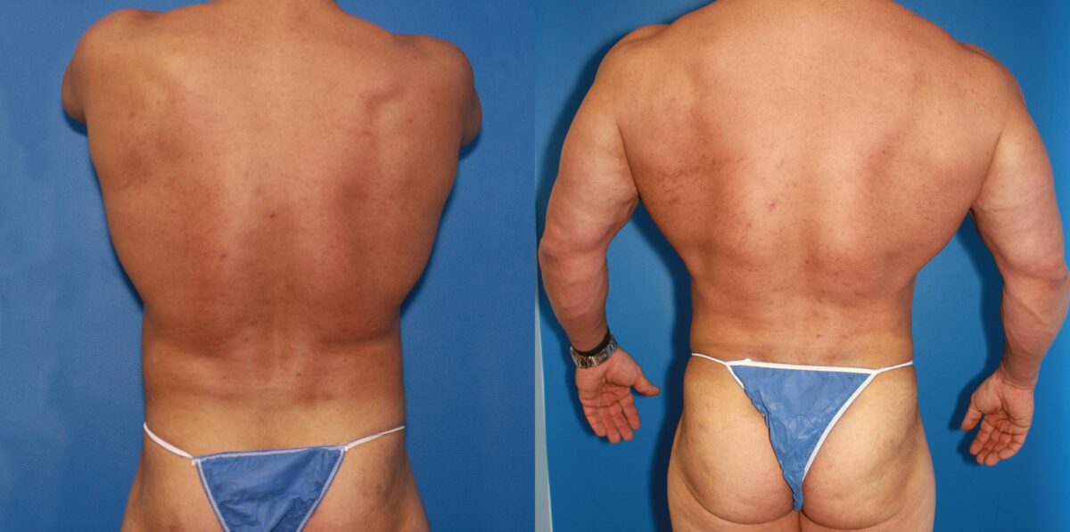 Daddy Do Over Before and After Photos in New York, NY, Patient 13630