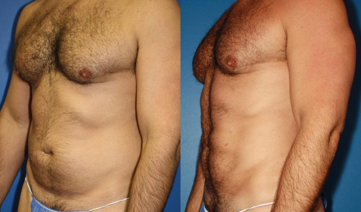 Daddy Do Over Before and After Photos in New York, NY, Patient 13643